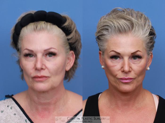 Before & After Face/Neck Lift Case 124 Front View in Boston, MA