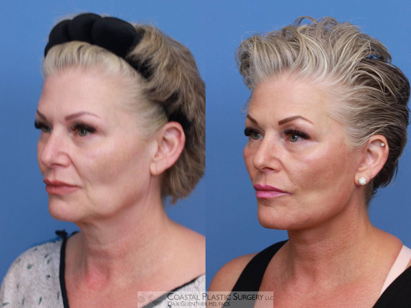 Before & After Face/Neck Lift Case 124 Right Oblique View in Boston, MA