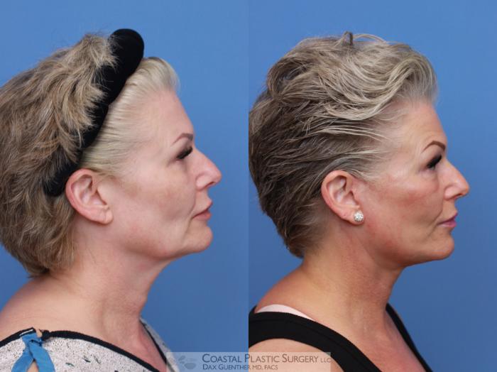 Before & After Face/Neck Lift Case 124 Right Side View in Boston, MA