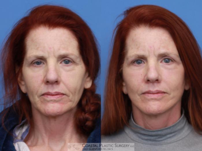 Before & After Face/Neck Lift Case 132 Front View in Boston, MA