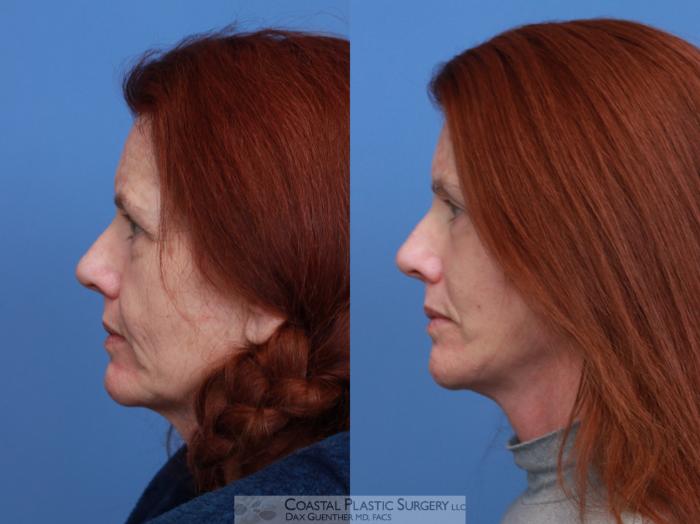 Before & After Face/Neck Lift Case 132 Left Side View in Boston, MA