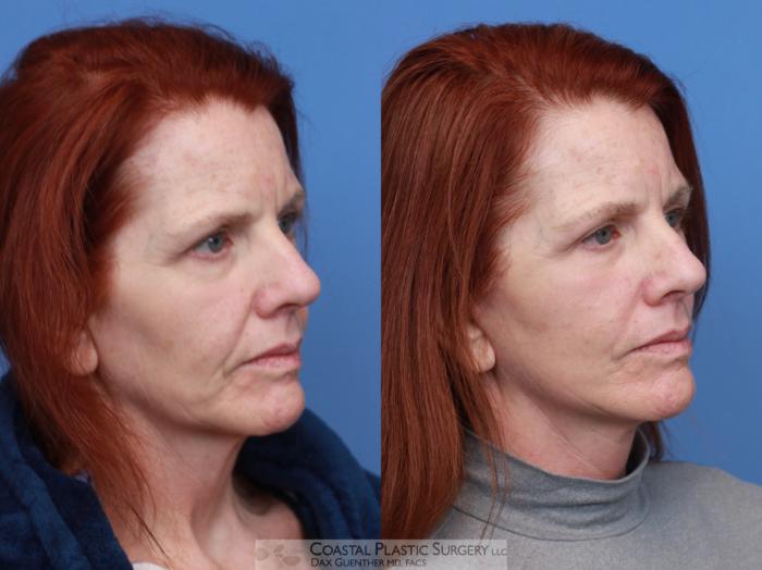 Before & After Face/Neck Lift Case 132 Right Oblique View in Boston, MA