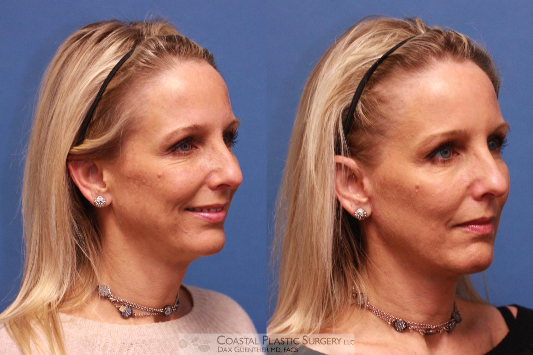 Before & After Face/Neck Lift Case 14 View #2 View in Boston, MA