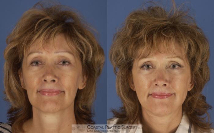 Before & After Face/Neck Lift Case 4 View #1 View in Hingham, MA