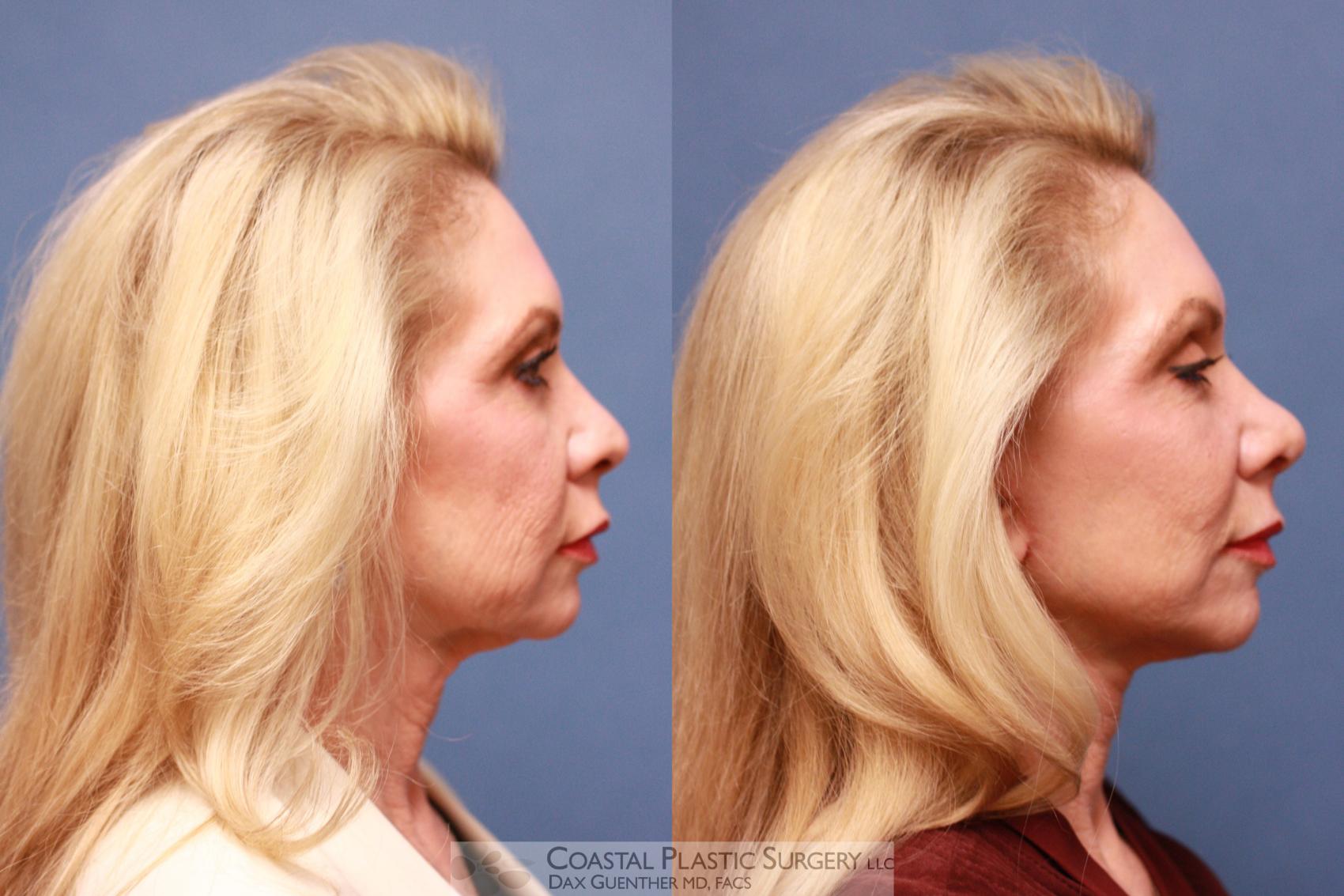 Before & After Face/Neck Lift Case 70 View #3 View in Boston, MA