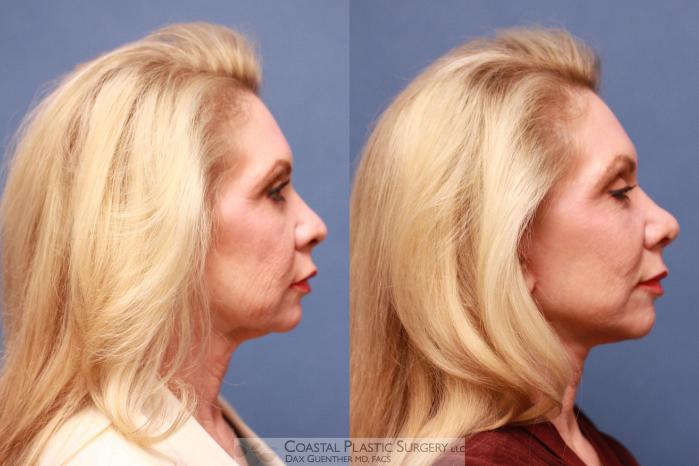 Before & After Face/Neck Lift Case 70 View #3 View in Hingham, MA
