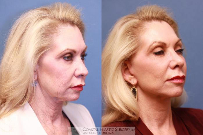Before & After Face/Neck Lift Case 70 View #4 View in Hingham, MA