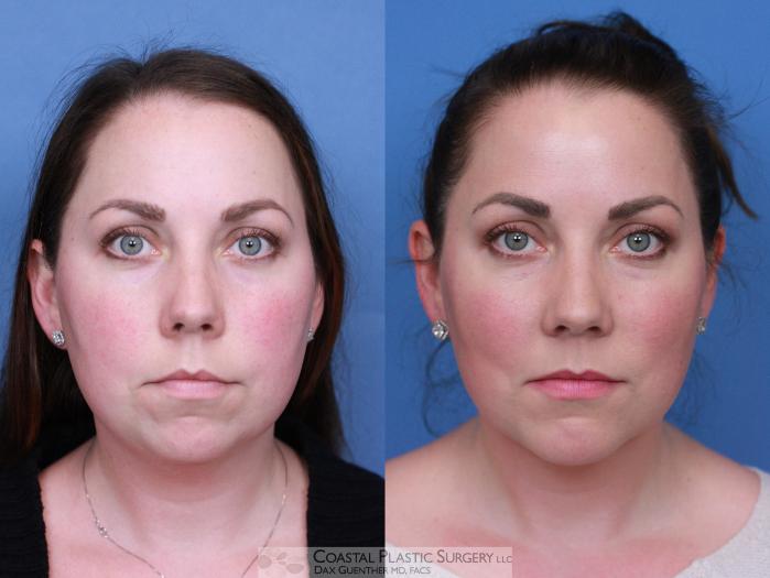 Before & After Facial Implants Case 112 Front View in Boston, MA