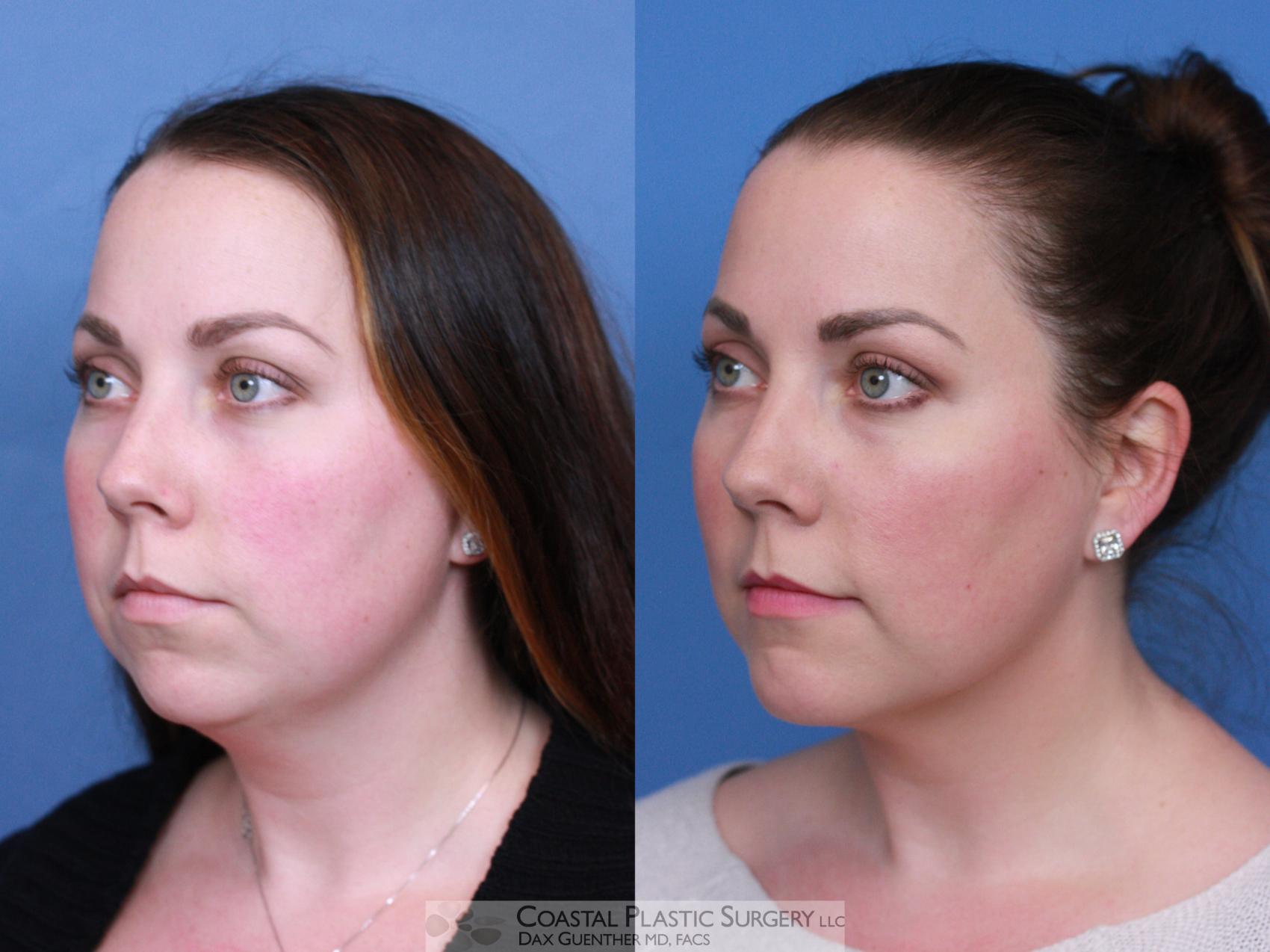 Before & After Facial Implants Case 112 Left Oblique View in Hingham, MA