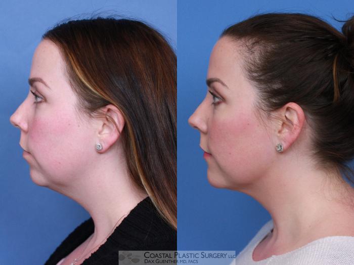 Before & After Facial Implants Case 112 Left Side View in Boston, MA