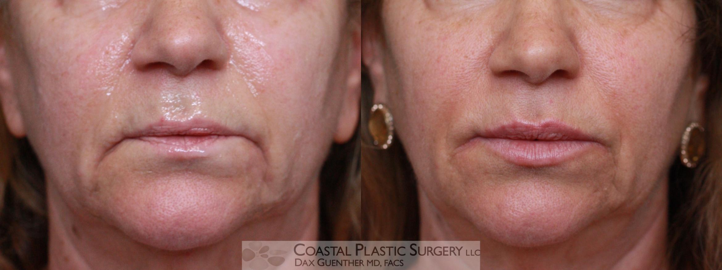 Before & After Fillers & Threads Case 107 Front View in Hingham, Boston & Nantucket, MA