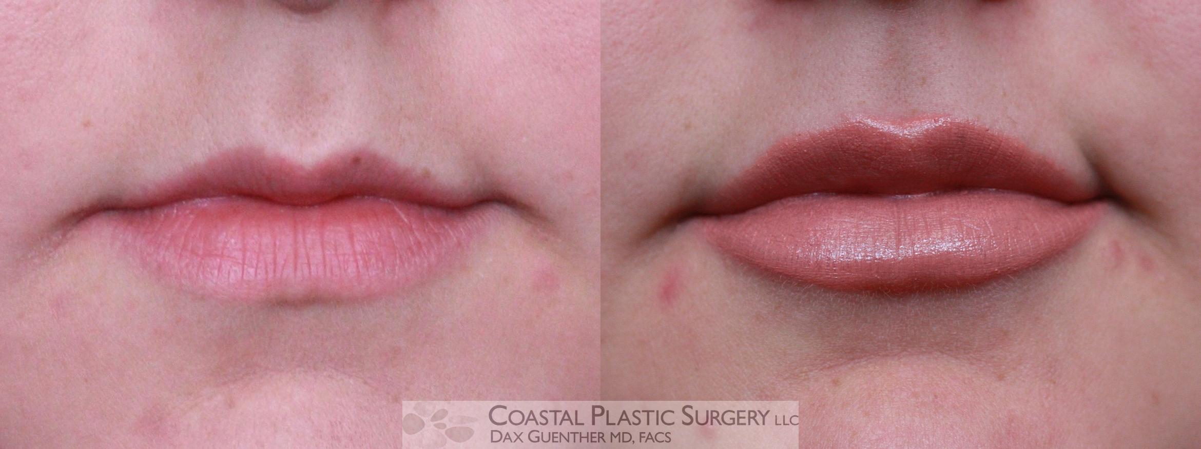 Before & After Fillers & Threads Case 93 Front View in Hingham, Boston & Nantucket, MA
