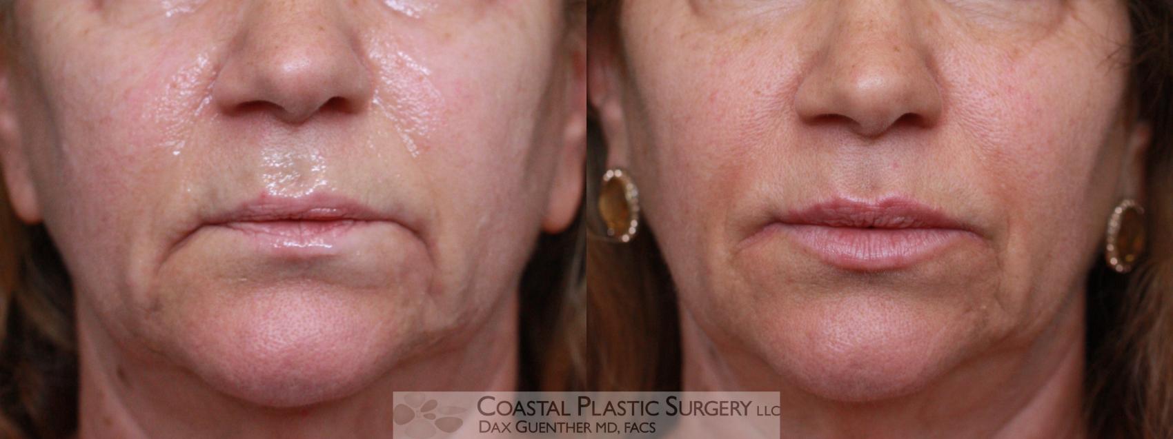 Before & After Fillers & Threads Case 107 Front View in Hingham, MA