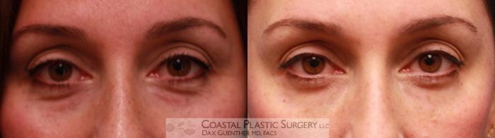 Before & After Fillers & Threads Case 74 Front View in Hingham, MA