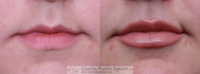 Before & After Fillers & Threads Case 93 Front View in Hingham, MA