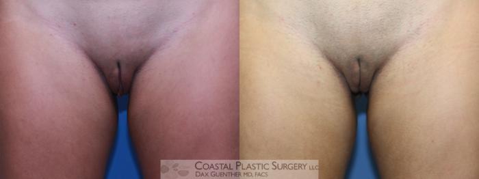 Before & After Labiaplasty Case 113 Front View in Boston, MA