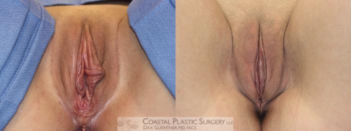 Before & After Labiaplasty Case 113 Supine View in Boston, MA