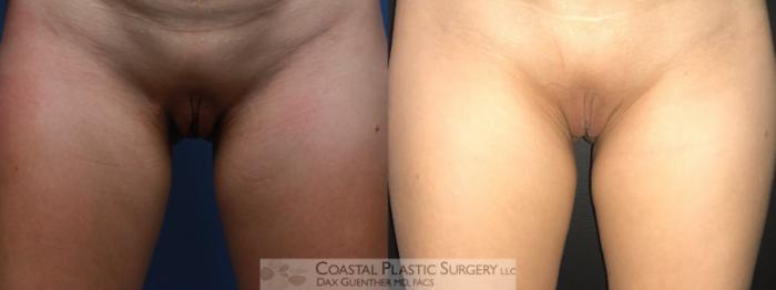 Before & After Labiaplasty Case 114 Front View in Boston, MA