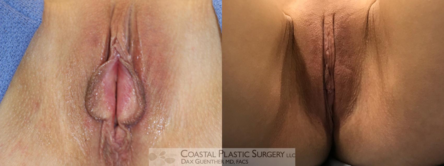 Before & After Labiaplasty Case 114 Supine View in Hingham, MA