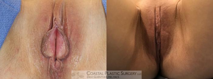 Before & After Labiaplasty Case 114 Supine View in Boston, MA