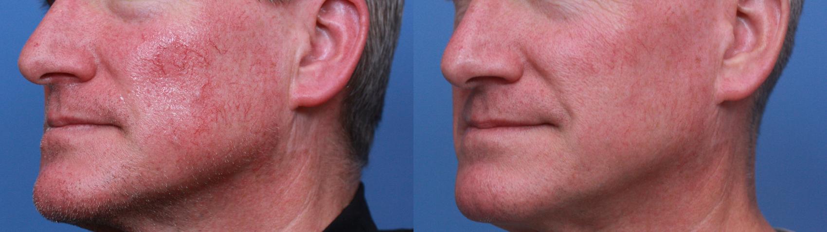 Before & After Lasers & Chemical Peels Case 119 Left Oblique View in Boston, MA