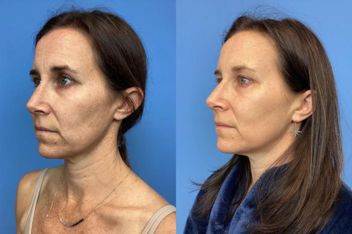 Before & After Lasers & Chemical Peels Case 125 Right Oblique View in Boston, MA