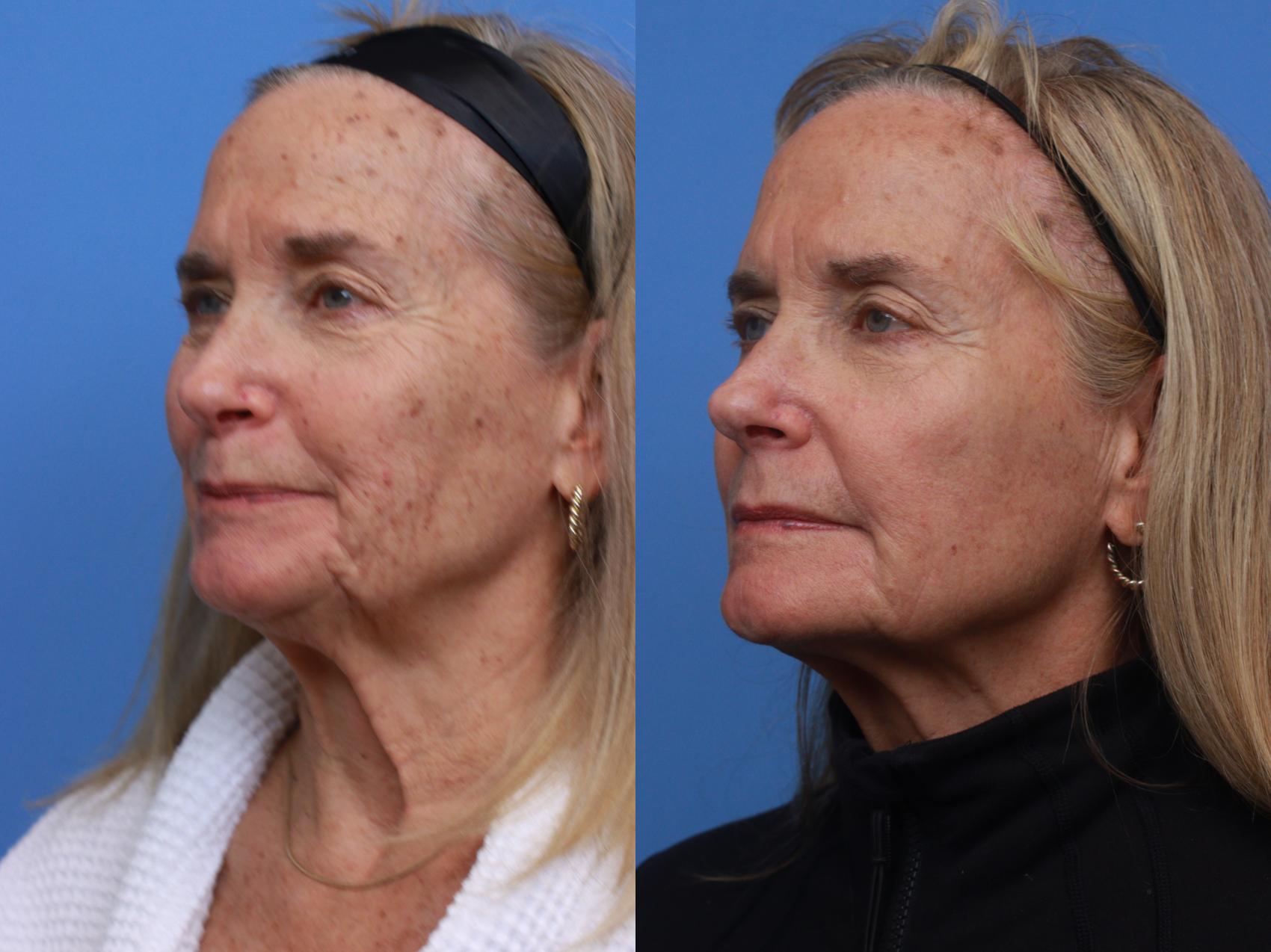 Before & After Lasers & Chemical Peels Case 126 Right Oblique View in Boston, MA