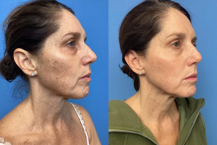 Before & After Lasers & Chemical Peels Case 127 Left Oblique View in Boston, MA