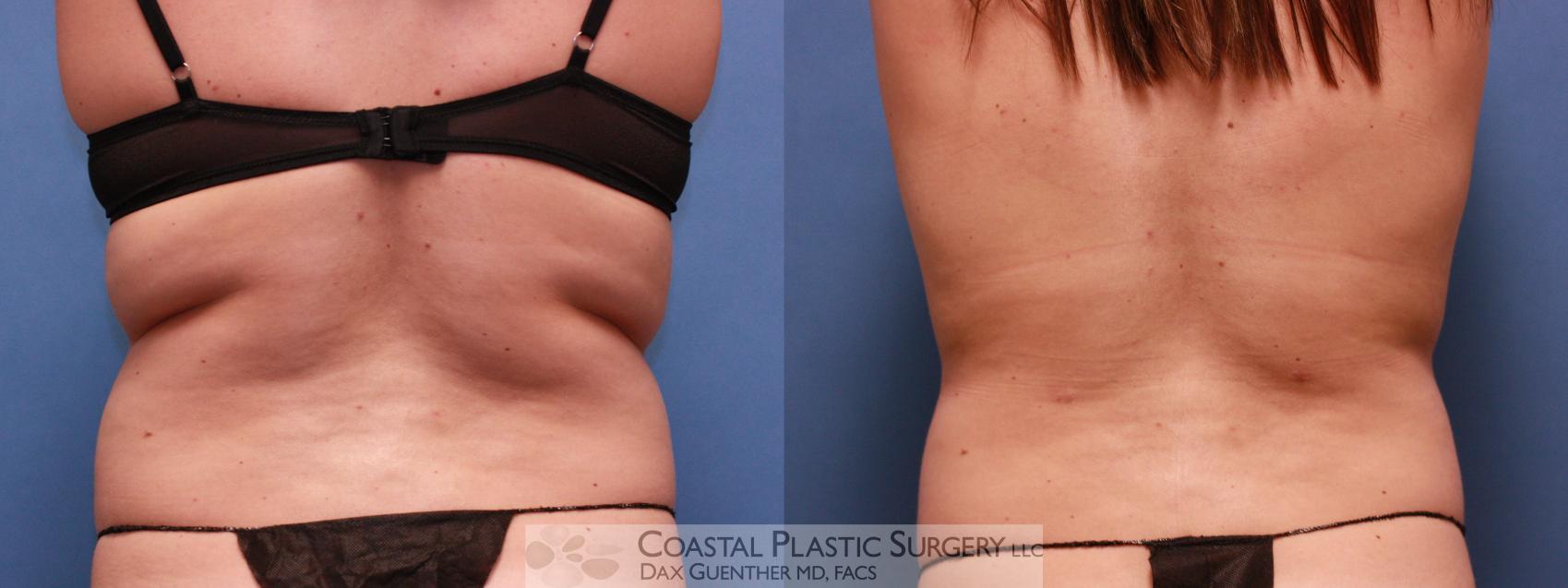 Before & After Liposuction Case 23 View #1 View in Hingham, MA