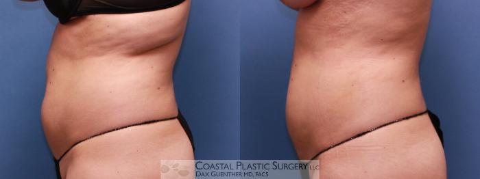 Before & After Liposuction Case 23 View #2 View in Boston, MA