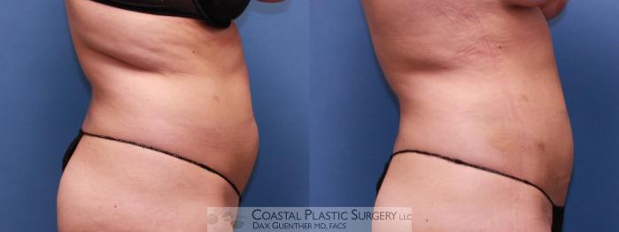Before & After Liposuction Case 23 View #3 View in Boston, MA