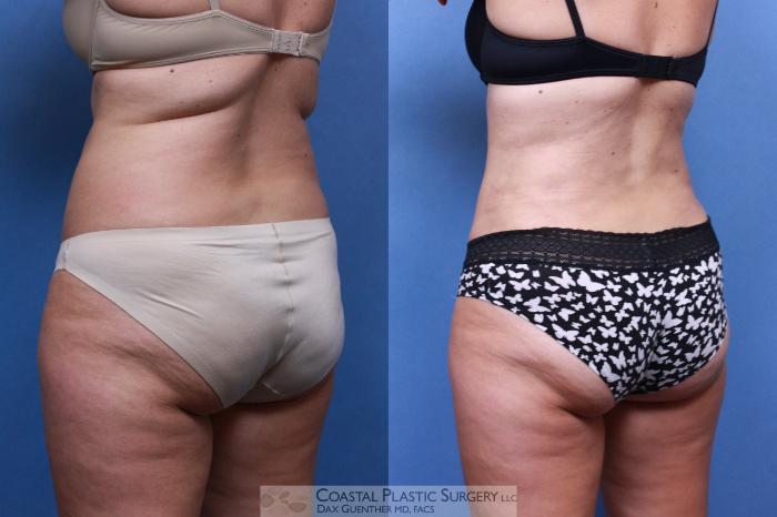 Before & After Liposuction Case 97 View #1 View in Boston, MA