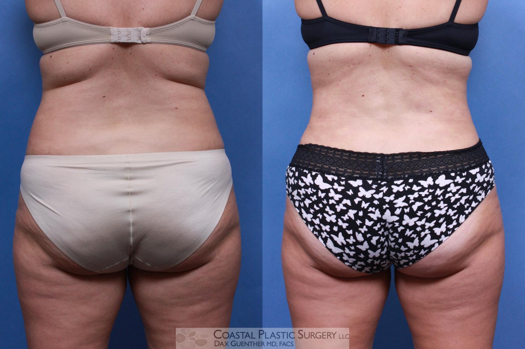 Before & After Liposuction Case 97 View #2 View in Boston, MA