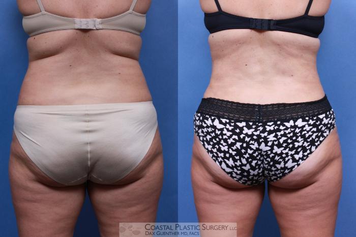 Before & After Liposuction Case 97 View #2 View in Boston, MA