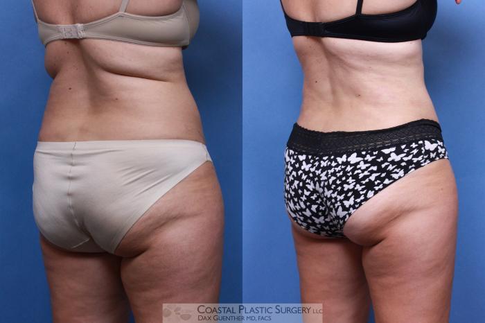 Before & After Liposuction Case 97 View #3 View in Boston, MA