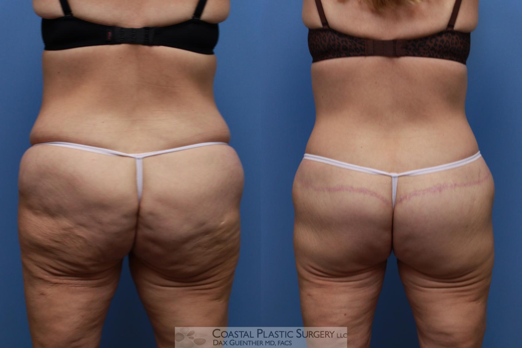 Before & After Lower Body Lift / Belt Lipectomy Case 137 Back View in Boston, MA