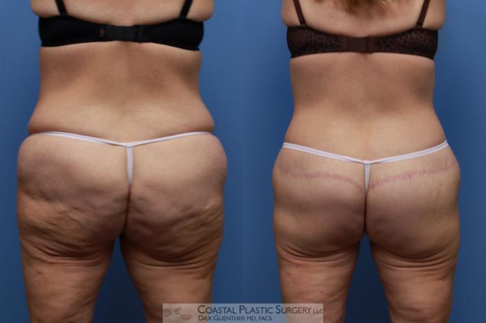 Before & After Lower Body Lift / Belt Lipectomy Case 137 Back View in Boston, MA