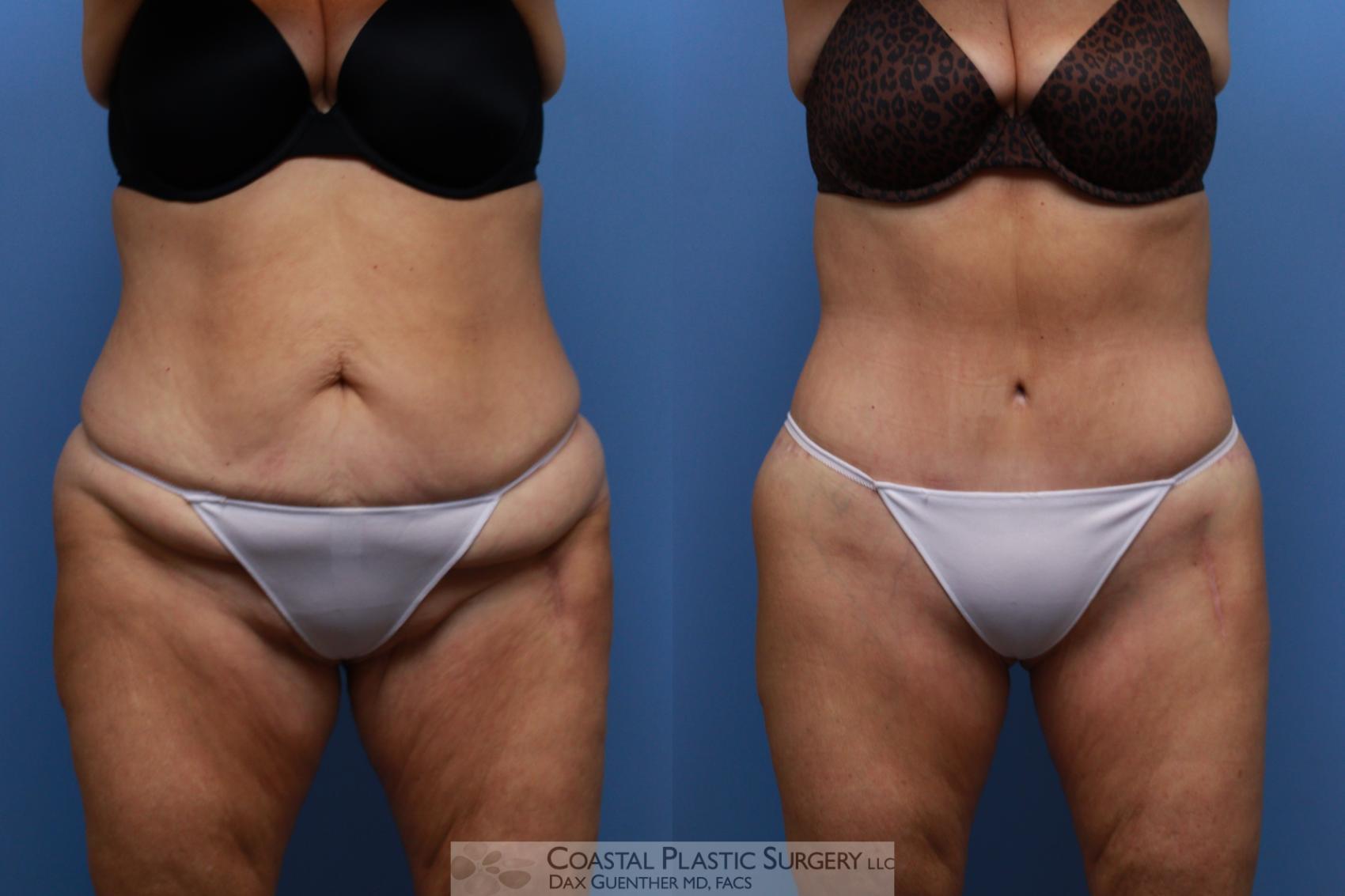 Before & After Lower Body Lift / Belt Lipectomy Case 137 Front View in Boston, MA