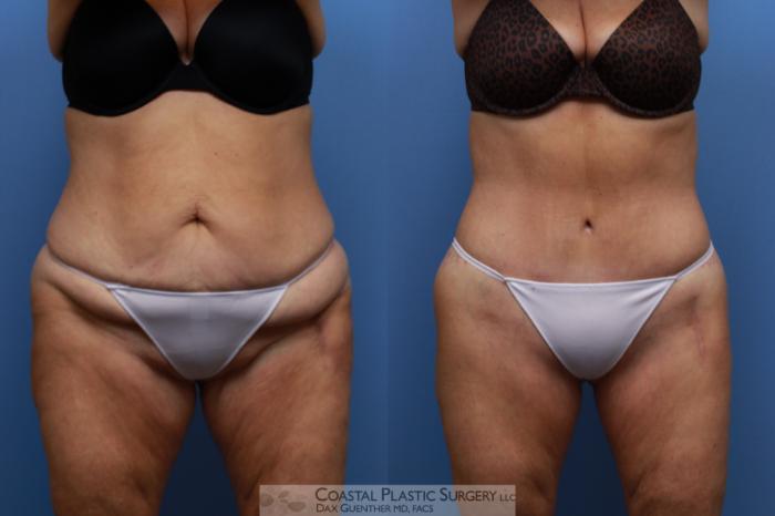 Before & After Lower Body Lift / Belt Lipectomy Case 137 Front View in Boston, MA