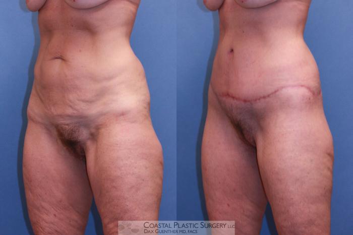 Before & After Lower Body Lift (Belt Lipectomy) Case 56 View #1 View in Hingham, MA