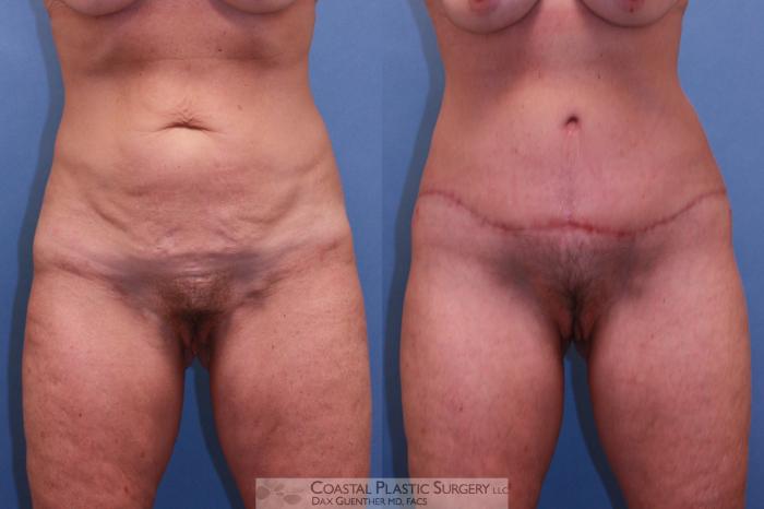 Before & After Lower Body Lift (Belt Lipectomy) Case 56 View #2 View in Boston, MA