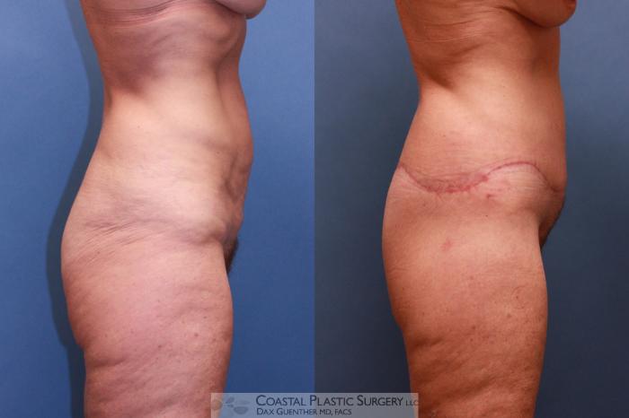 Before & After Lower Body Lift (Belt Lipectomy) Case 56 View #3 View in Boston, MA