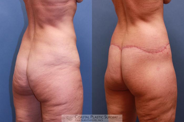 Before & After Lower Body Lift (Belt Lipectomy) Case 56 View #4 View in Boston, MA