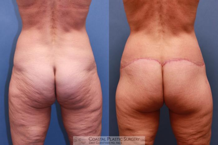 Before & After Lower Body Lift (Belt Lipectomy) Case 56 View #5 View in Boston, MA