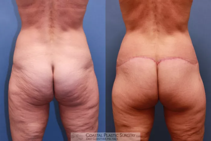 Lower Body Lift (Belt Lipectomy) Before & After Photos Patient 56, Boston,  MA