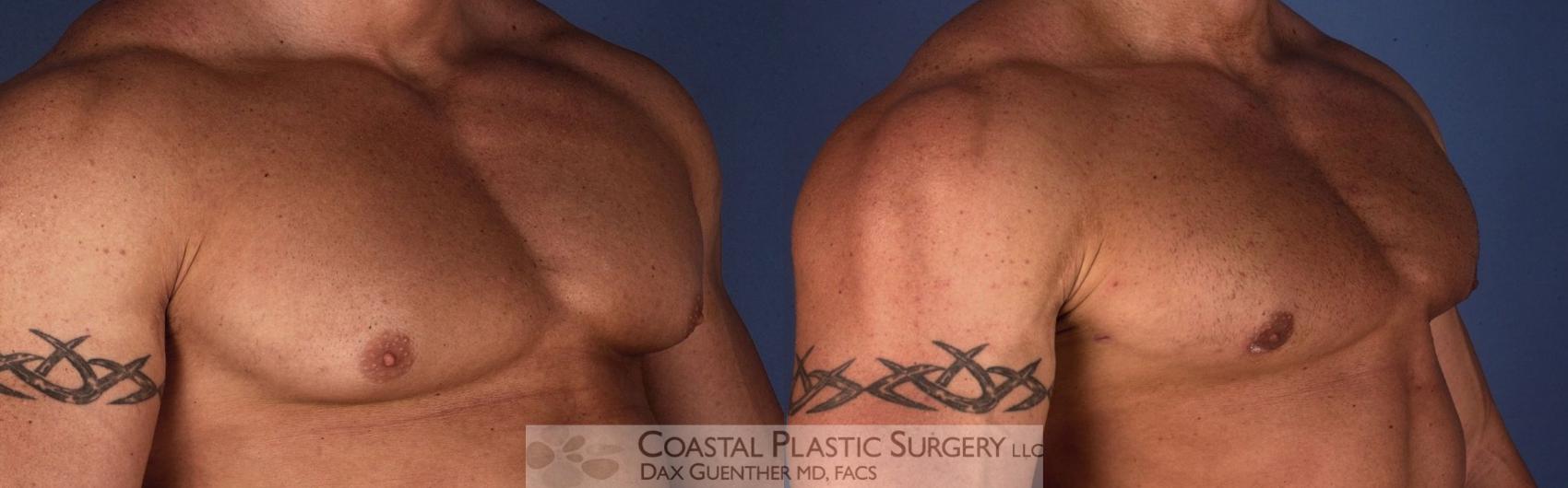 Before & After Male Breast Reduction (Gynecomastia) Case 2 View #2 View in Hingham, Boston & Nantucket, MA