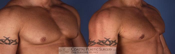 Before & After Male Breast Reduction (Gynecomastia) Case 2 View #2 View in Boston, MA