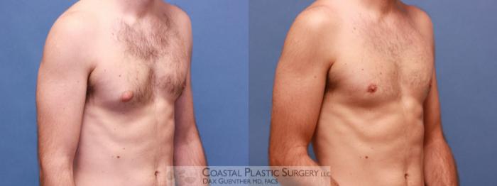 Before & After Male Breast Reduction (Gynecomastia) Case 28 View #2 View in Boston, MA
