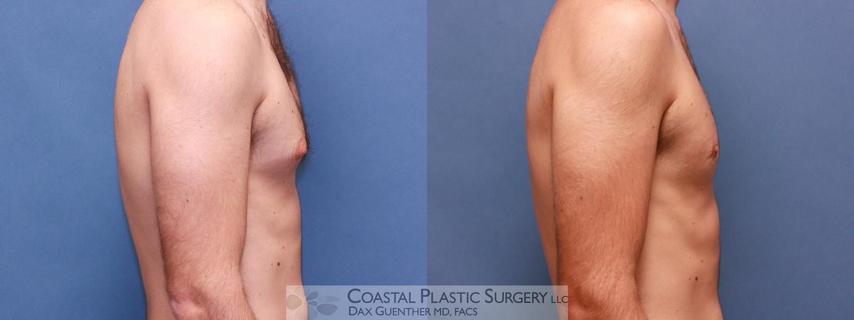 Before & After Male Breast Reduction (Gynecomastia) Case 28 View #3 View in Hingham, Boston & Nantucket, MA