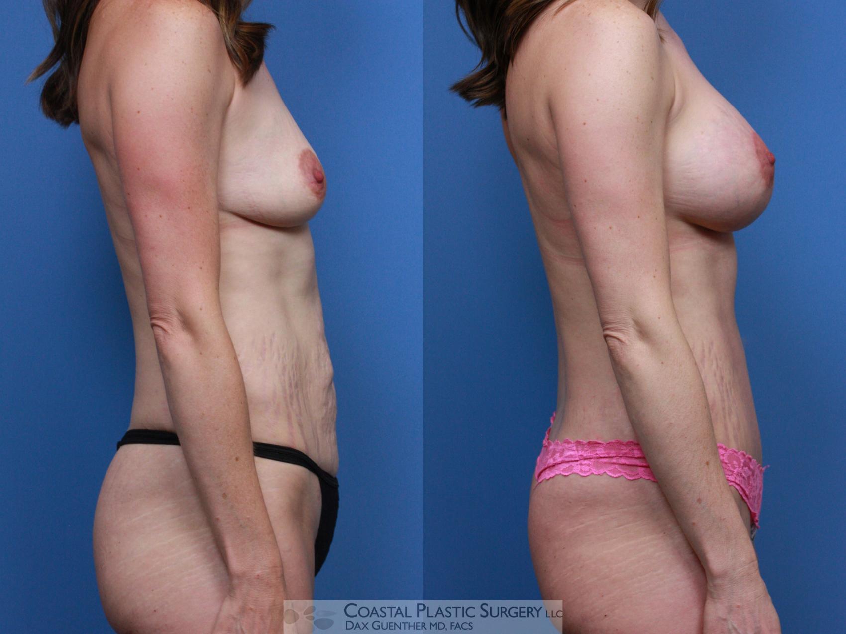 Before & After Mommy Makeover Case 116 Right Side View in Boston, MA